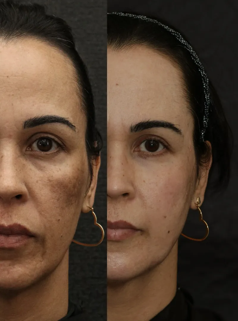 Antes e depois do tratamento Line Skin: melasma no rosto